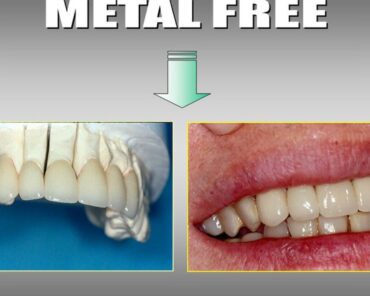 Metal Free