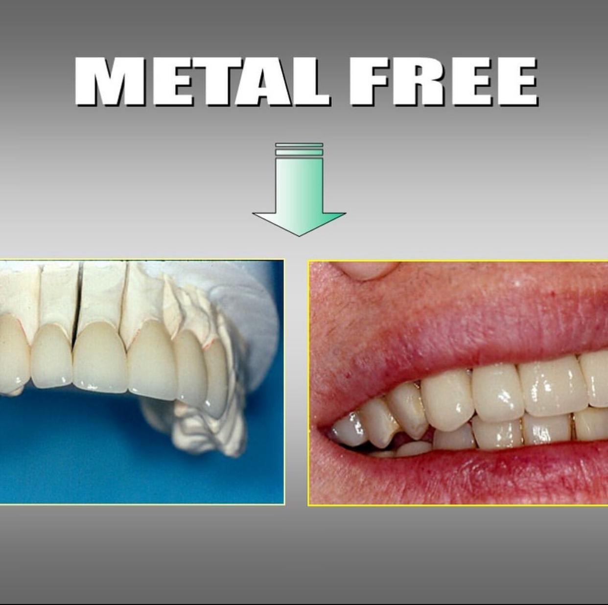 metal-free